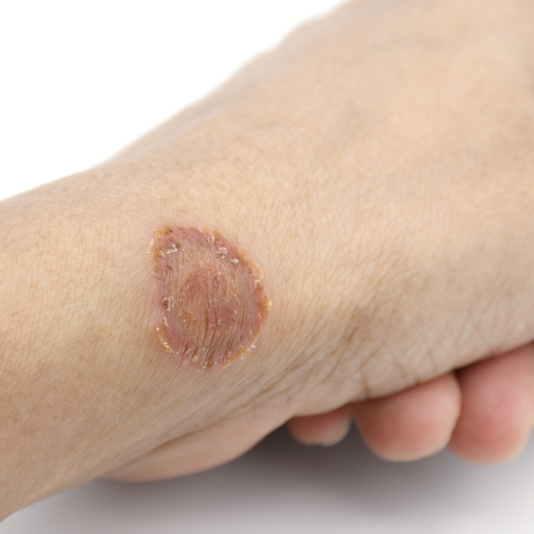 microsporum-canis-lesion-fungus-infections-human-skin-transmitted-by-contact_Easy-Resize.com